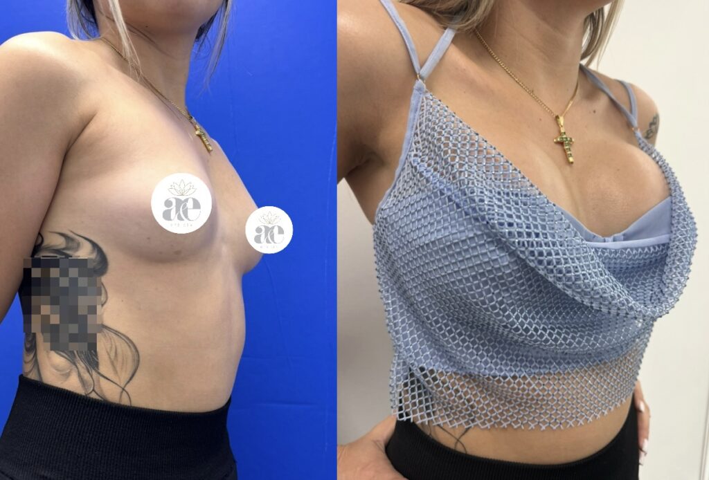 Breast augmentation before and after side view showing enhanced volume and natural projection at A&E Plastic Surgery Miami