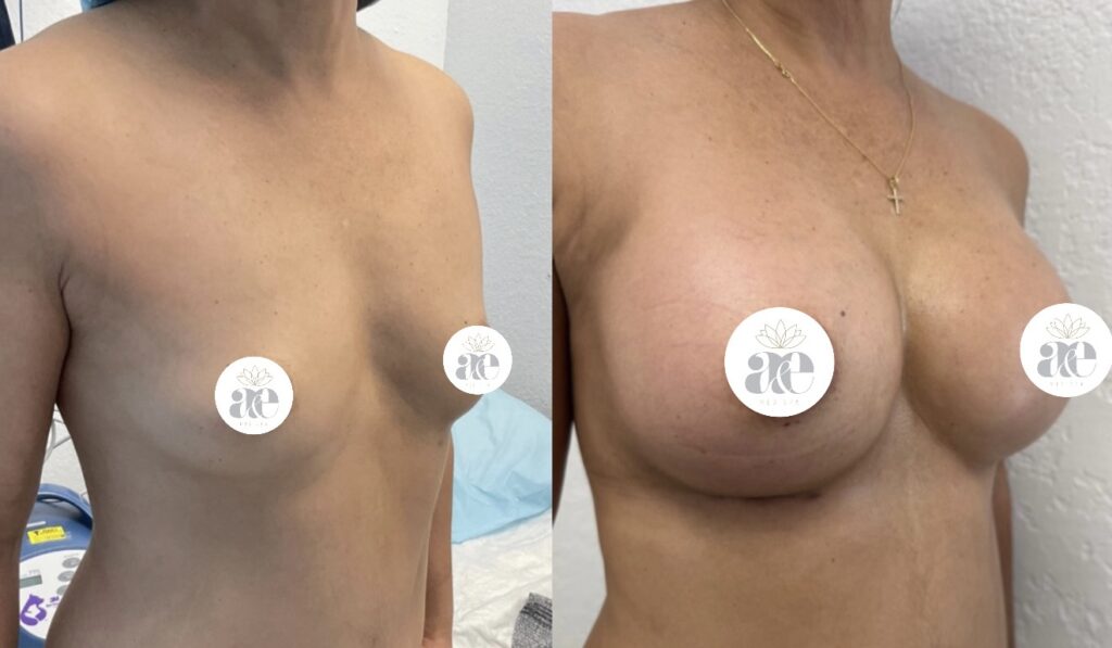 Breast augmentation before and after oblique view showing dramatic volume increase and natural projection at A&E Plastic Surgery Miami