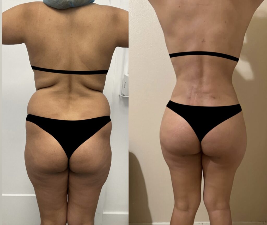 BBL and lipo 360 before and after back view showing snatched waist and lifted buttocks at A&E Plastic Surgery Miami