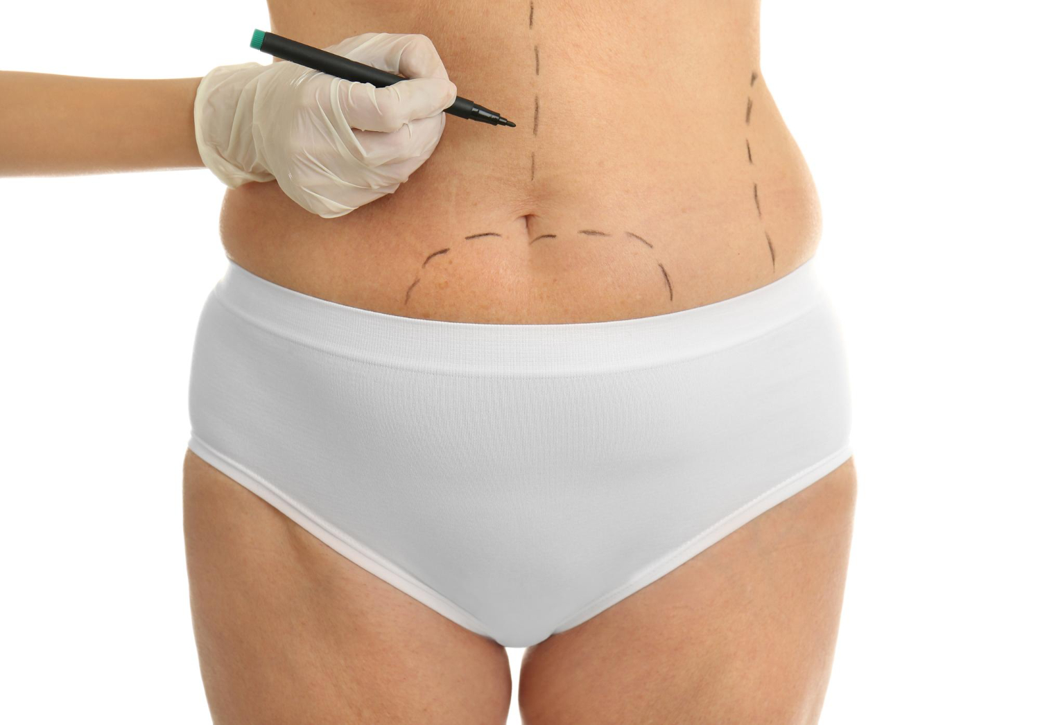 liposucción en Miami