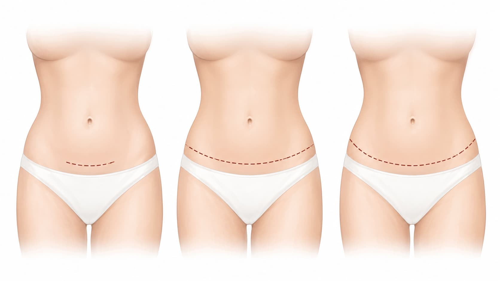 Ilustración que compara los tipos de incisión en la abdominoplastia mini, completa y extendida.